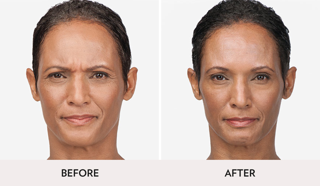 Botox Dysport Before After | Spa Radiance Medical | San Francisco Med Spa