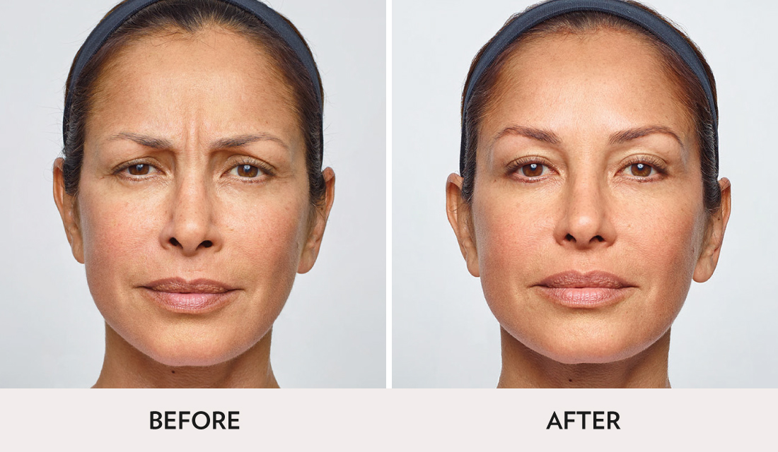 Botox Dysport Before After | Spa Radiance Medical | San Francisco Med Spa