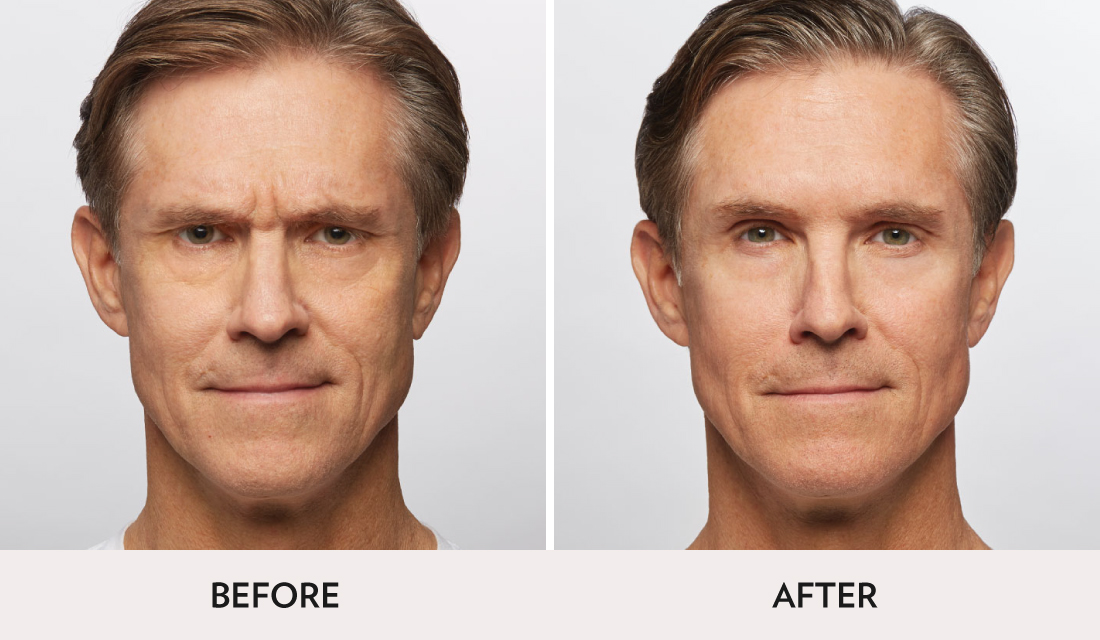 Botox Dysport Before After | Spa Radiance Medical | San Francisco Med Spa