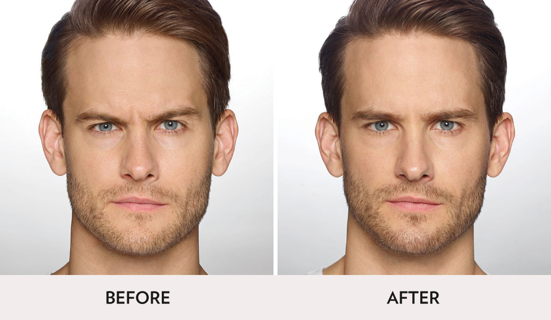 Botox Dysport Before After | Spa Radiance Medical | San Francisco Med Spa