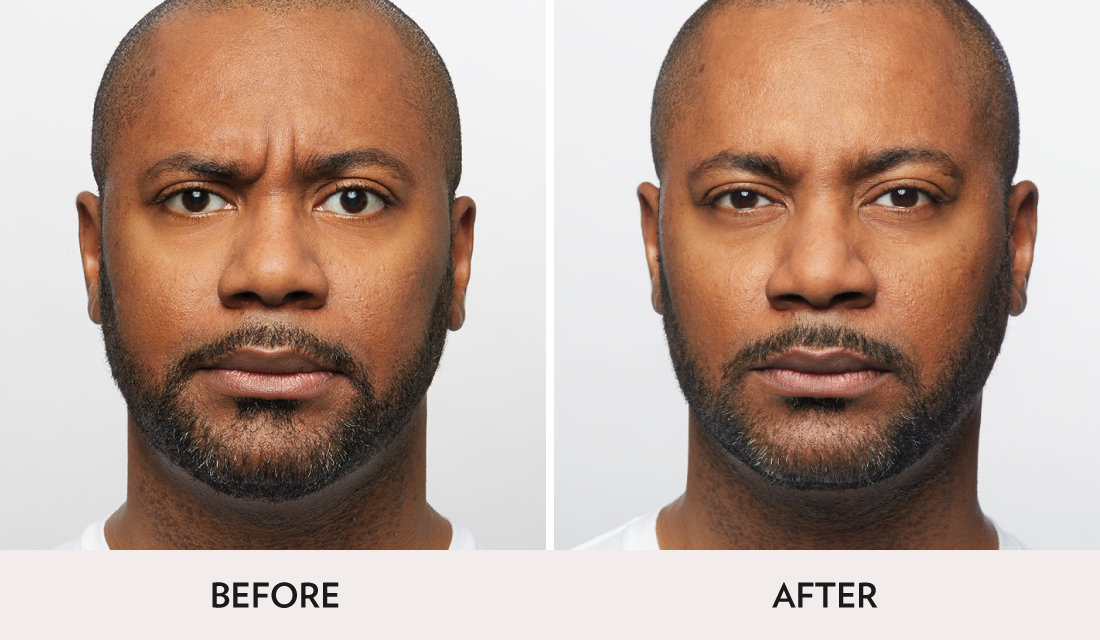 Botox Dysport Before After | Spa Radiance Medical | San Francisco Med Spa