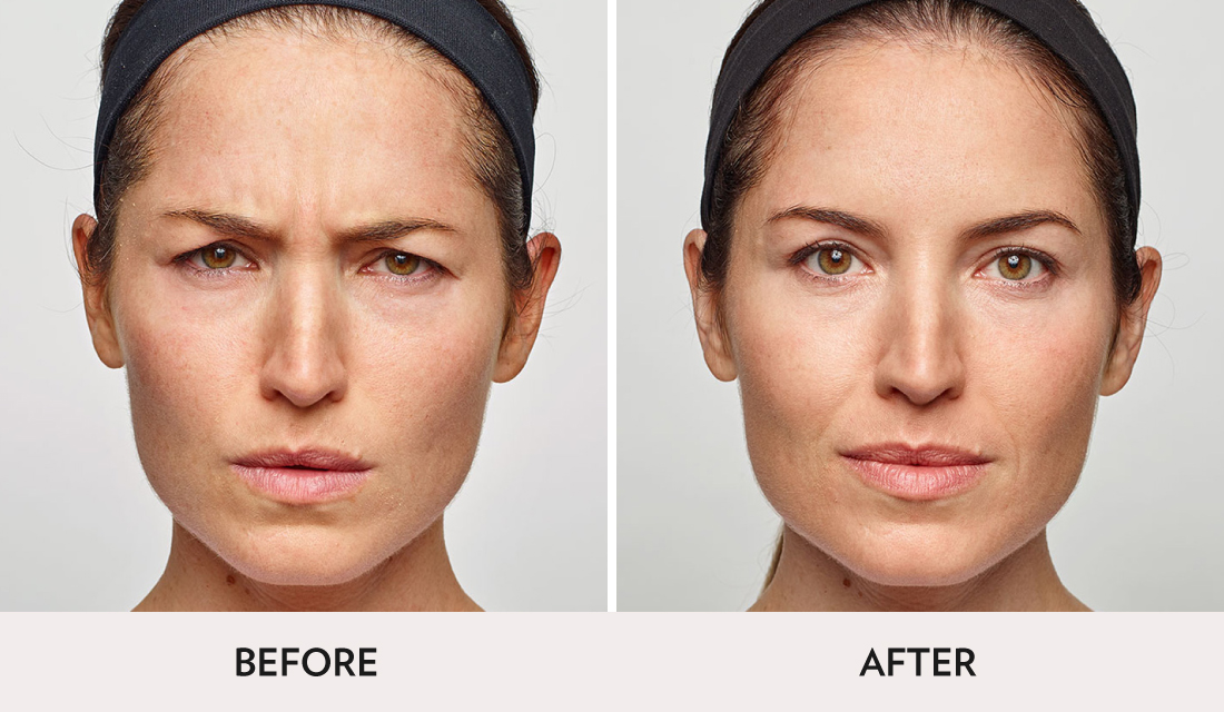 Botox Dysport Before After | Spa Radiance Medical | San Francisco Med Spa