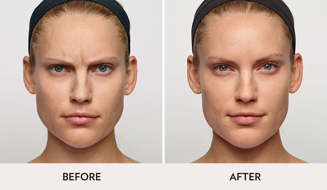 Botox Dysport Before After | Spa Radiance Medical | San Francisco Med Spa