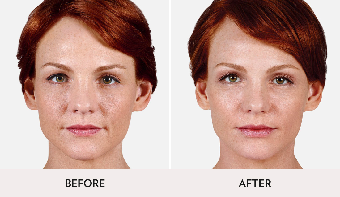 Fillers Injectibles Sculptra Before After | Spa Radiance Medical | San Francisco Med Spa