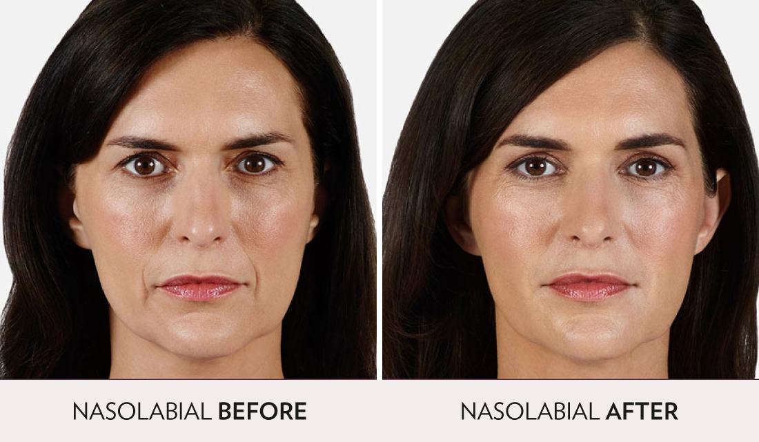 Fillers Injectibles Sculptra Before After | Spa Radiance Medical | San Francisco Med Spa