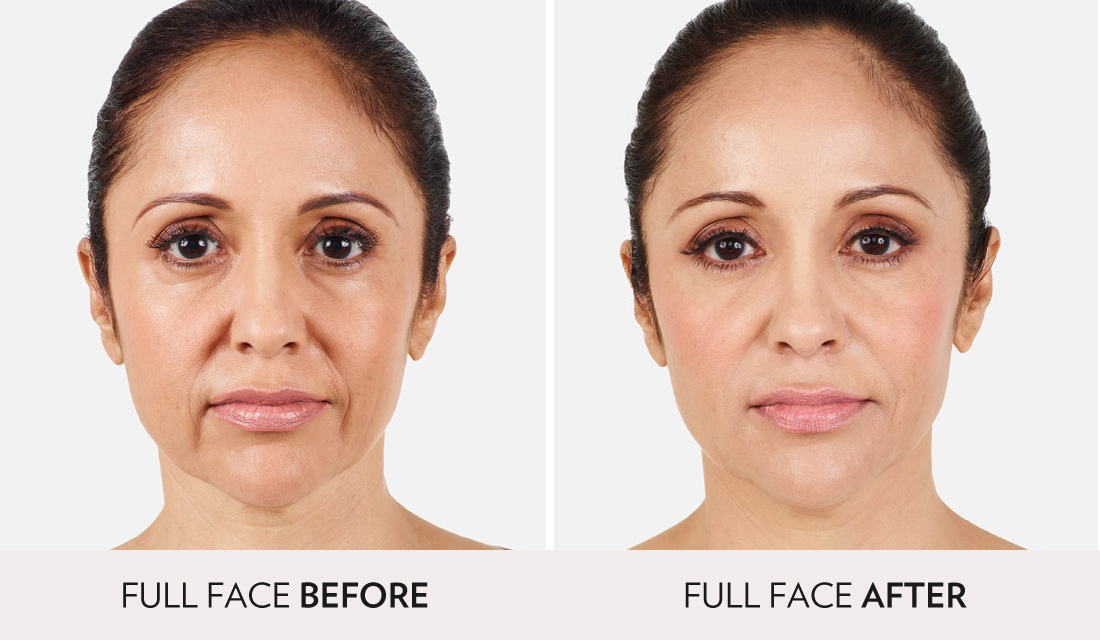 Fillers Injectibles Sculptra Before After | Spa Radiance Medical | San Francisco Med Spa