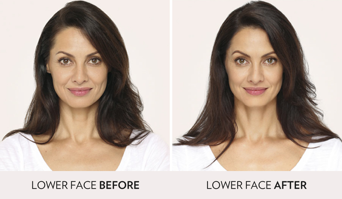 Fillers Injectibles Sculptra Before After | Spa Radiance Medical | San Francisco Med Spa