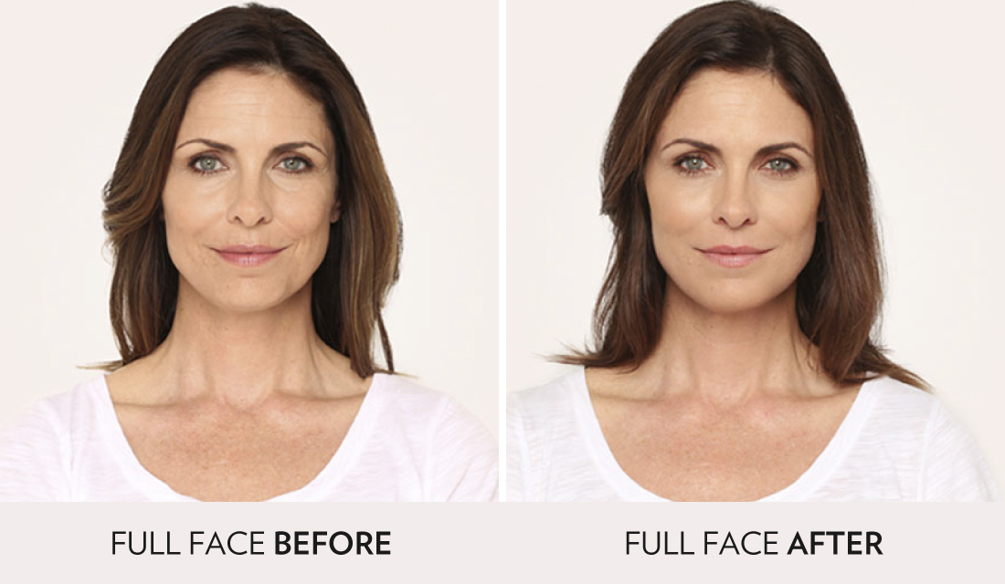 Fillers Injectibles Sculptra Before After | Spa Radiance Medical | San Francisco Med Spa