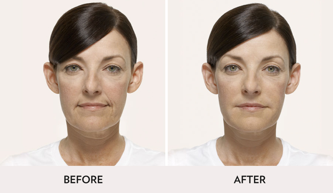 Fillers Injectibles Sculptra Before After | Spa Radiance Medical | San Francisco Med Spa