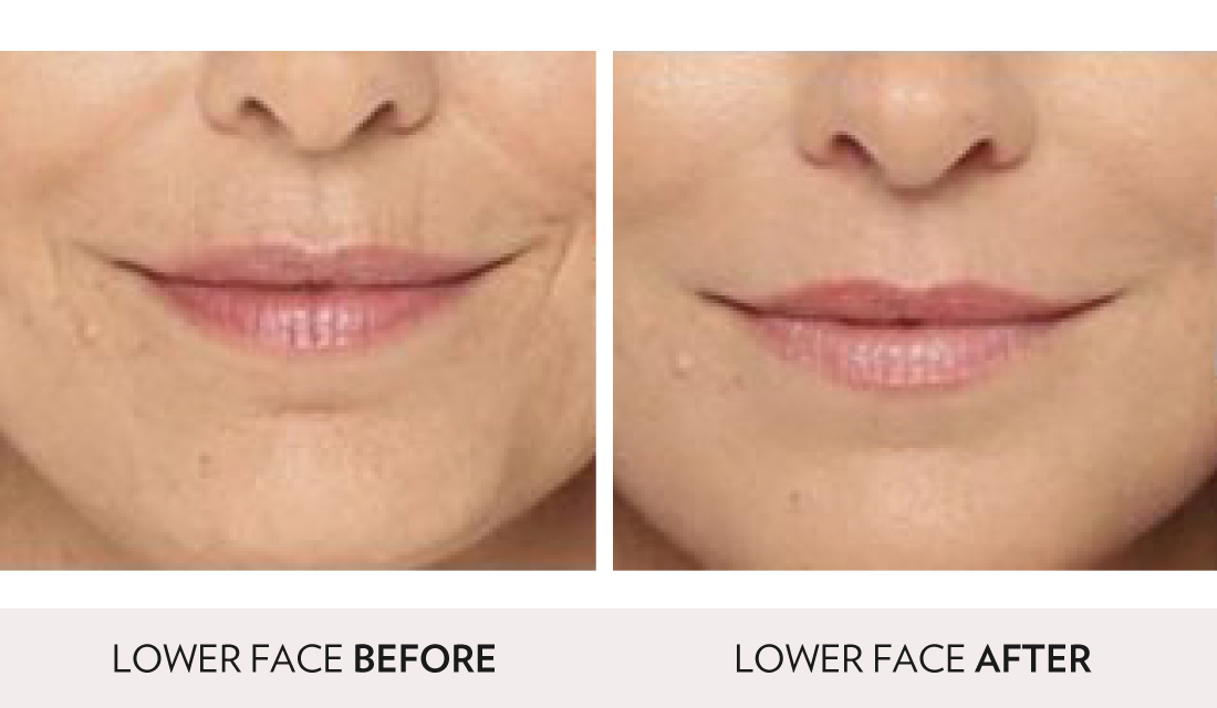 Fillers Injectibles Sculptra Before After | Spa Radiance Medical | San Francisco Med Spa