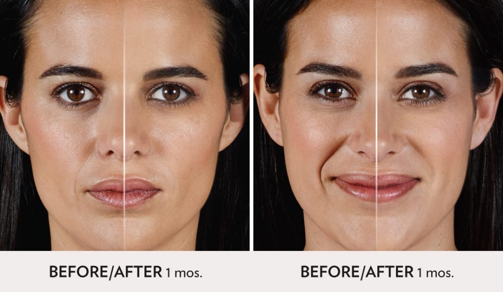 Radiance Injection Fillers - Spa Radiance Medical