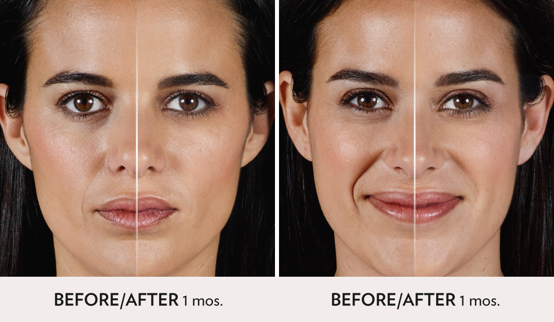 Fillers Injectibles Sculptra Before After | Spa Radiance Medical | San Francisco Med Spa