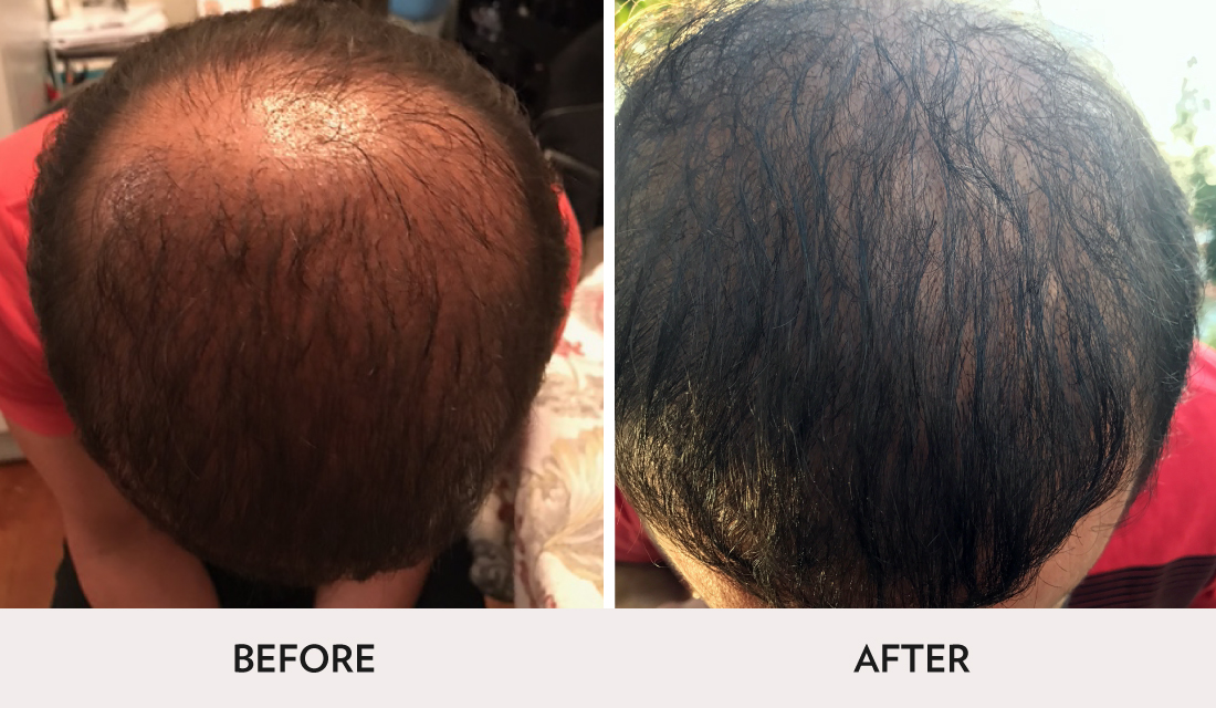 Hair Restoration Before After | Spa Radiance Medical | San Francisco Med Spa