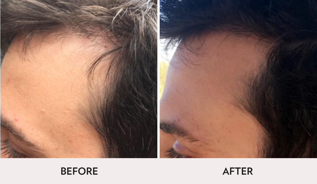 Hair Restoration Before After | Spa Radiance Medical | San Francisco Med Spa