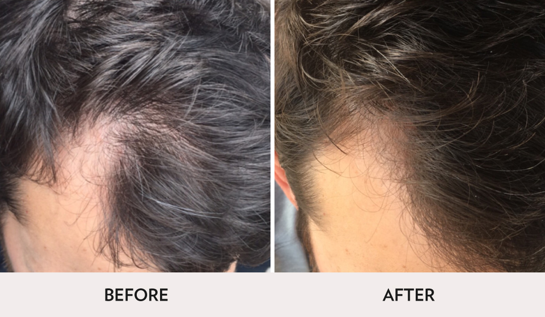 Hair Restoration Before After | Spa Radiance Medical | San Francisco Med Spa