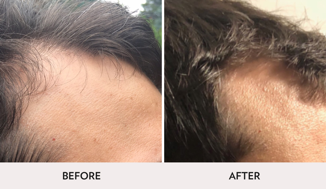 Hair Restoration Before After | Spa Radiance Medical | San Francisco Med Spa