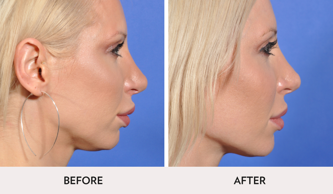 Kybella Before After | Spa Radiance Medical | San Francisco Med Spa