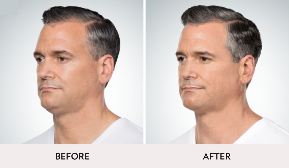 Kybella Before After | Spa Radiance Medical | San Francisco Med Spa