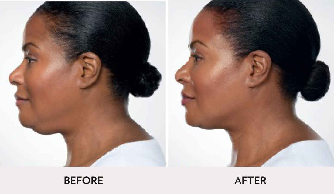 Kybella Before After | Spa Radiance Medical | San Francisco Med Spa