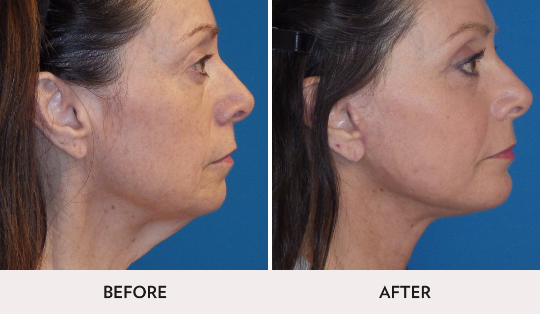 Kybella Before After | Spa Radiance Medical | San Francisco Med Spa