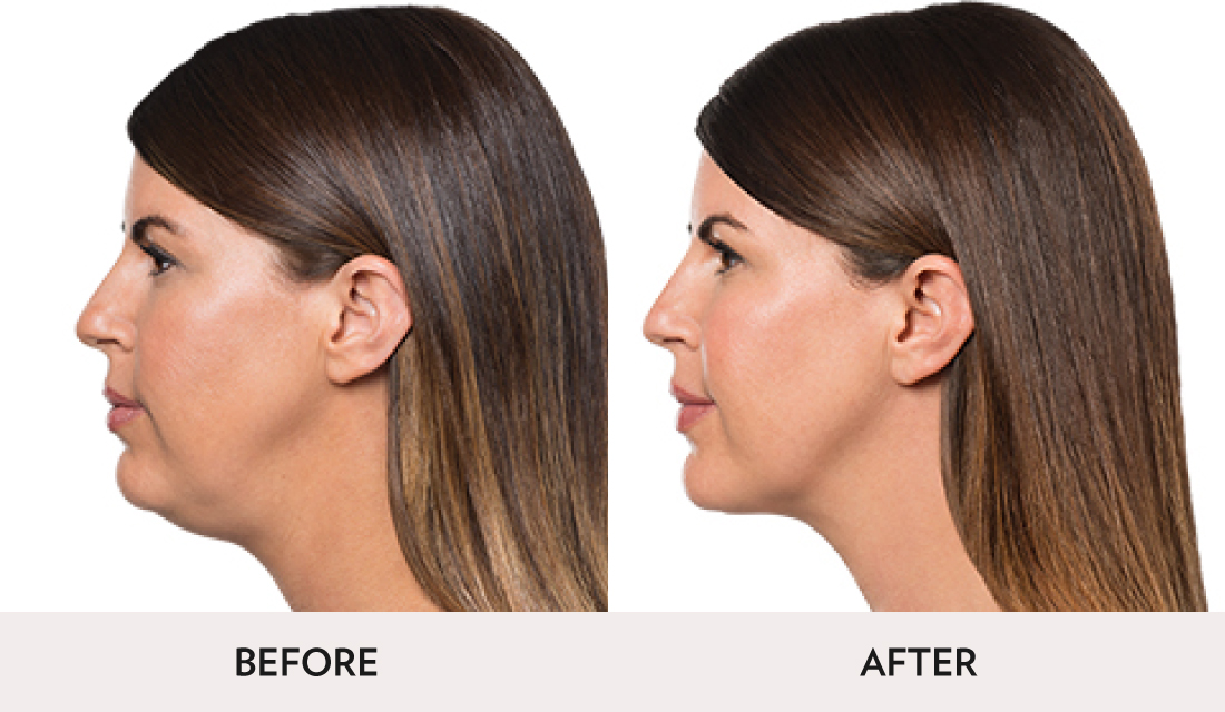 Kybella Before After | Spa Radiance Medical | San Francisco Med Spa