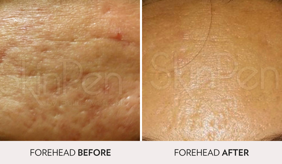 Microneedling & PRP Before After | Spa Radiance Medical | San Francisco Med Spa