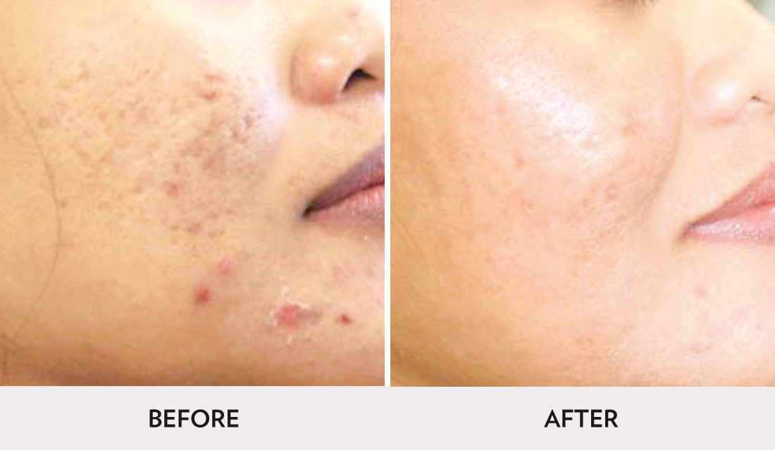 ProFractional Before After | Spa Radiance Medical | San Francisco Med Spa