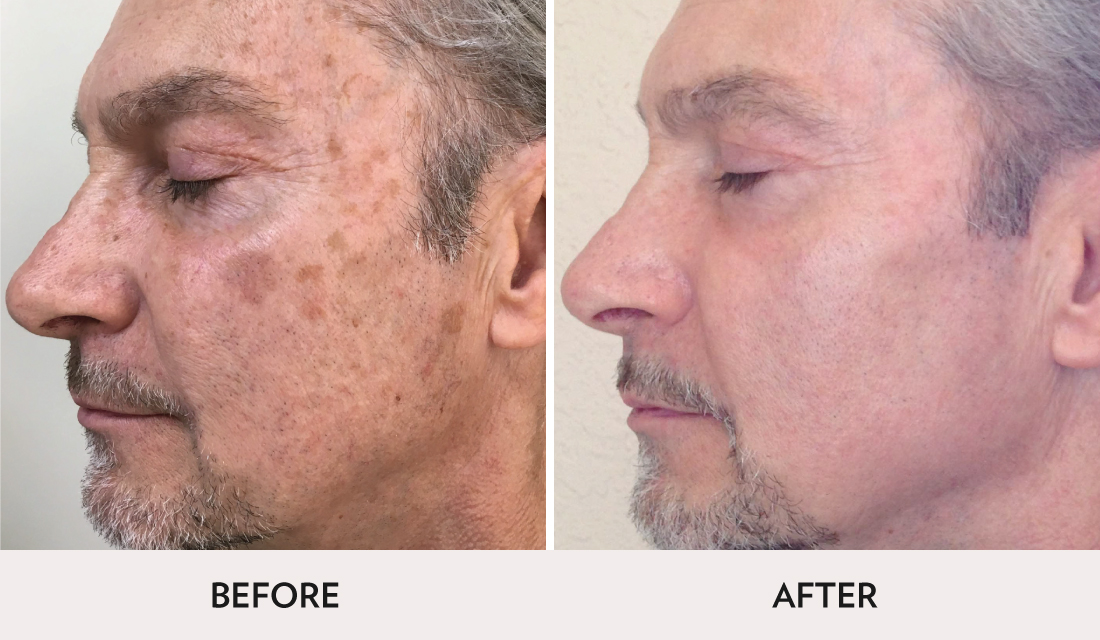 ProFractional Before After | Spa Radiance Medical | San Francisco Med Spa