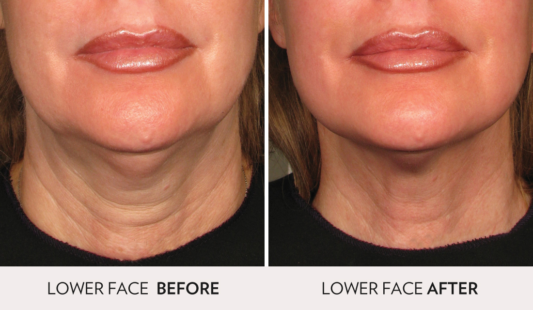 Ultherapy Before After | Spa Radiance Medical | San Francisco Med Spa