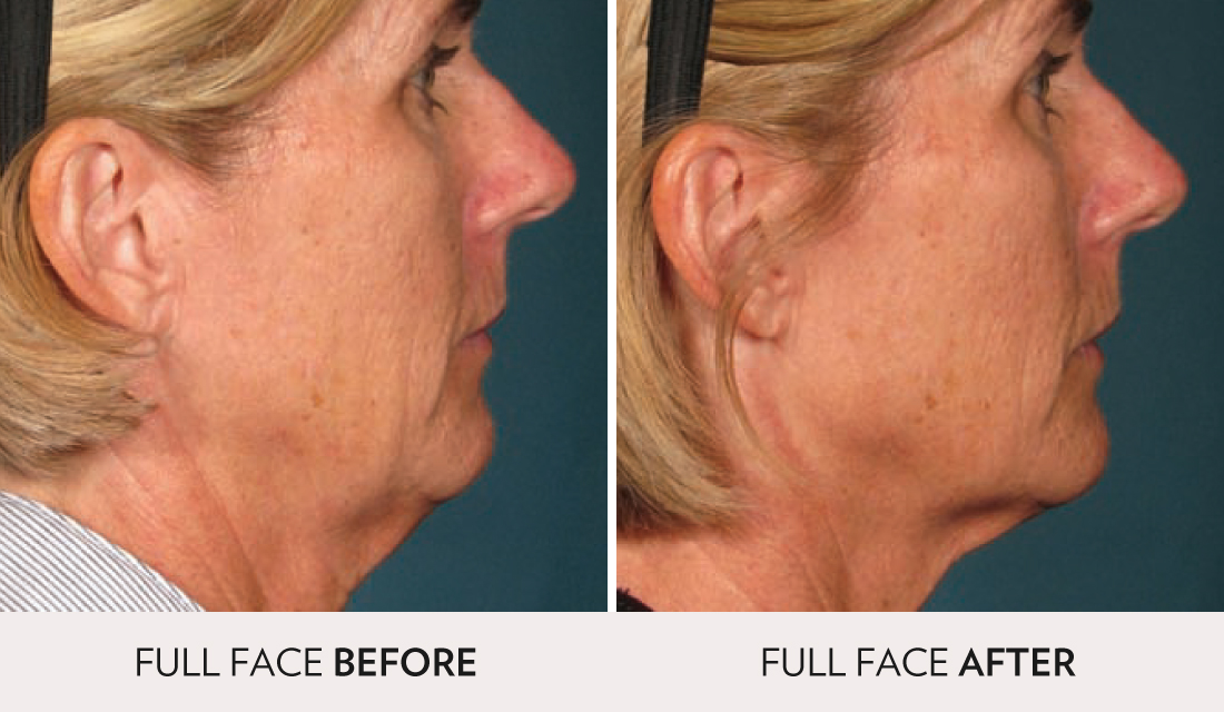 Ultherapy Before After | Spa Radiance Medical | San Francisco Med Spa