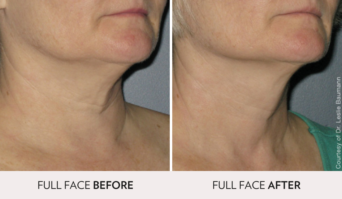 Ultherapy Before After | Spa Radiance Medical | San Francisco Med Spa