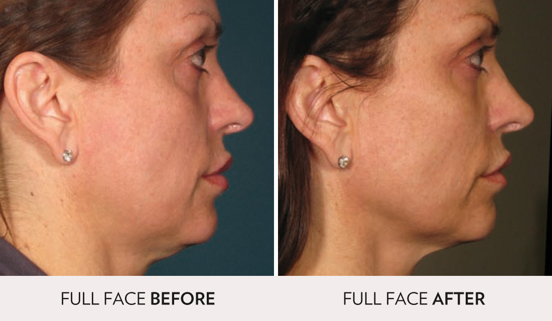 Ultherapy Before After | Spa Radiance Medical | San Francisco Med Spa