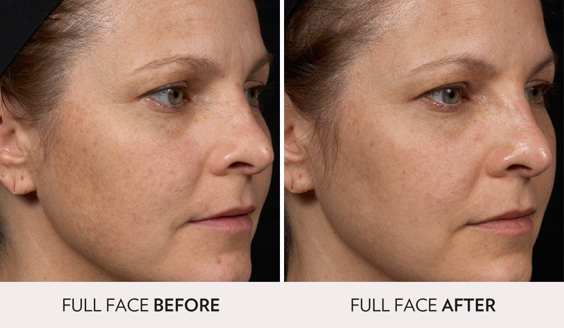 Clear and Brilliant Before After | Spa Radiance Medical | San Francisco Med Spa