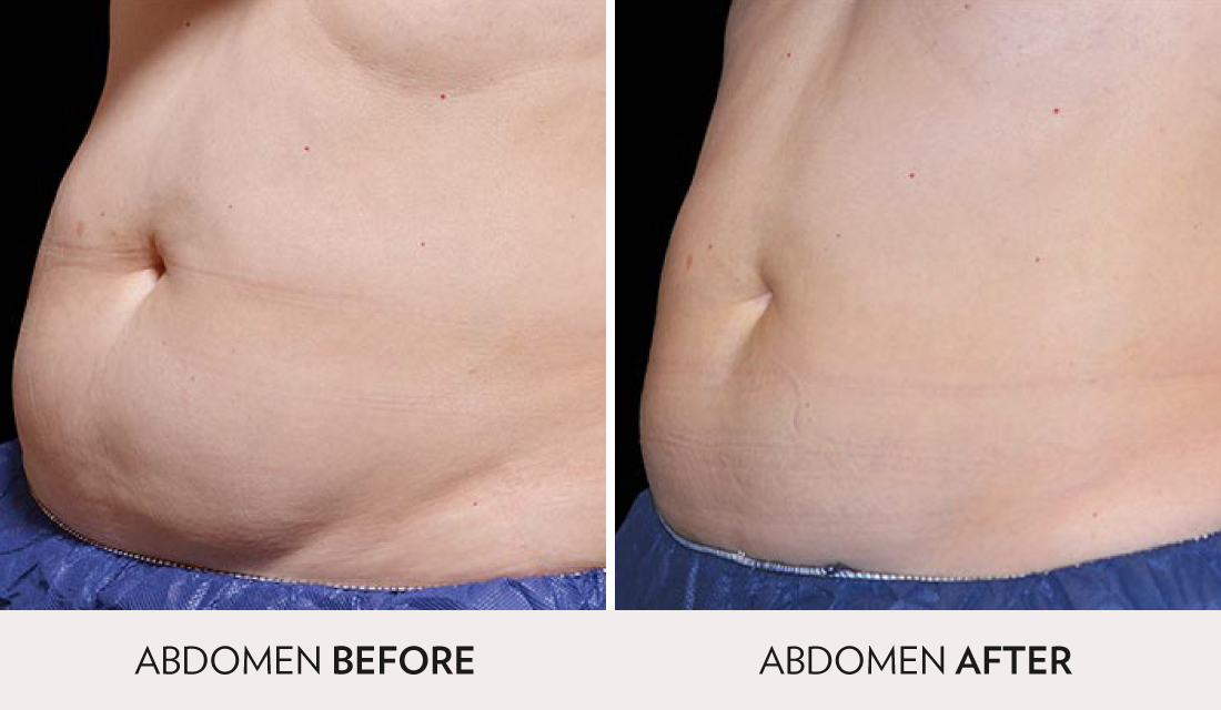 CoolSculpting Before After | Spa Radiance Medical | San Francisco Med Spa