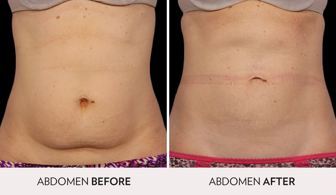 CoolSculpting Before After | Spa Radiance Medical | San Francisco Med Spa