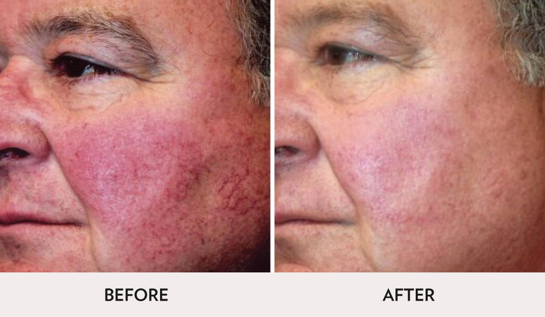 IPL Photofacial Before After | Spa Radiance Medical | San Francisco Med Spa