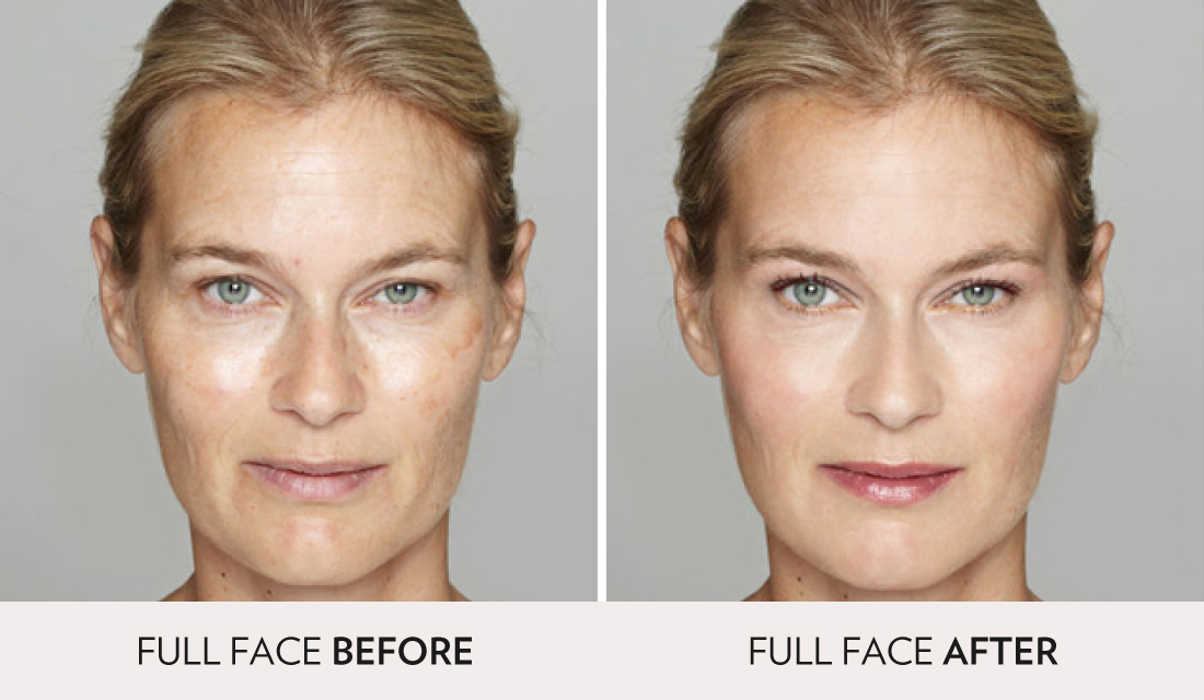 IPL Photofacial Before After | Spa Radiance Medical | San Francisco Med Spa