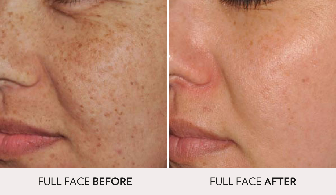 IPL Photofacial Before After | Spa Radiance Medical | San Francisco Med Spa