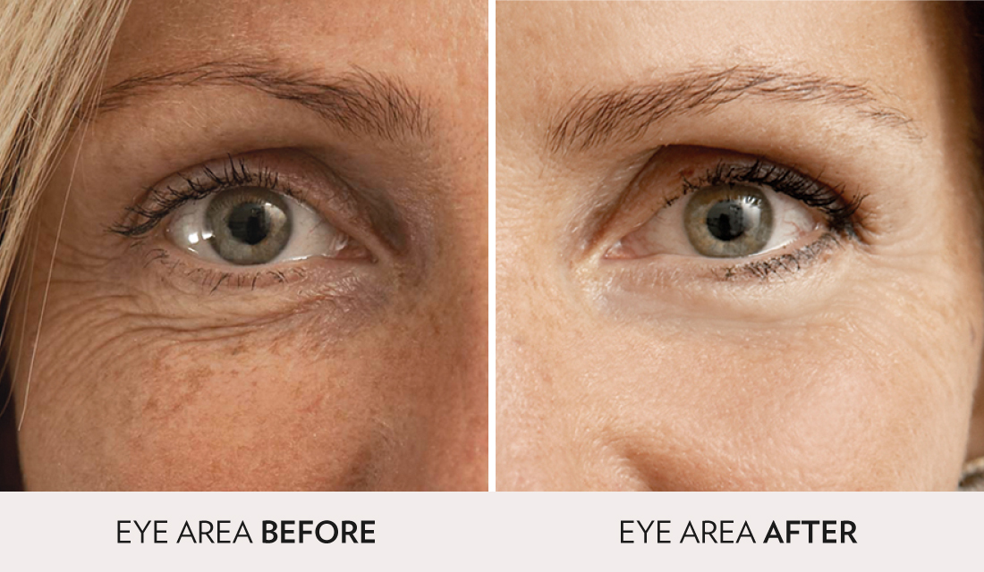 Mesotherapy - Spa Radiance Medical