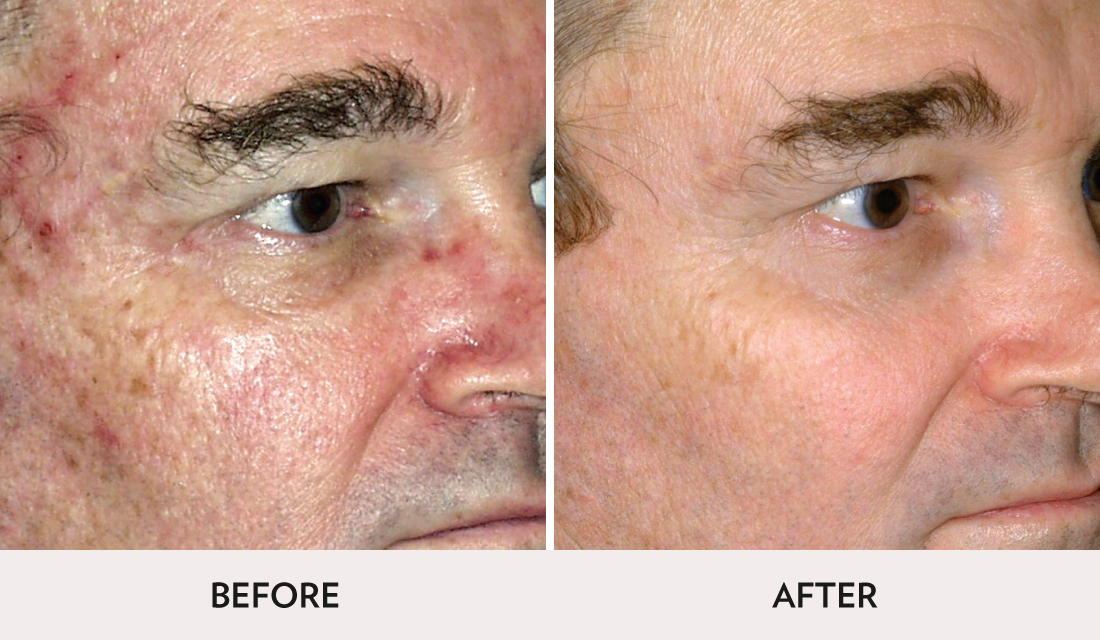 Micro Laser Peel Before After | Spa Radiance Medical | San Francisco Med Spa