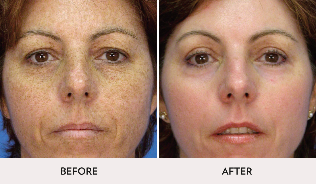 Micro Laser Peel Before After | Spa Radiance Medical | San Francisco Med Spa