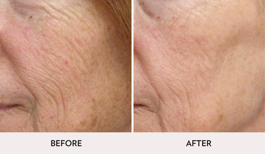 Micro Laser Peel Before After | Spa Radiance Medical | San Francisco Med Spa