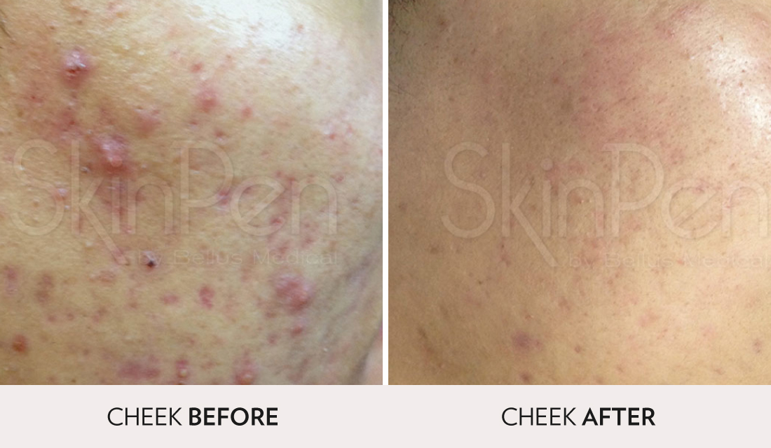 Microneedling & PRP Before After | Spa Radiance Medical | San Francisco Med Spa