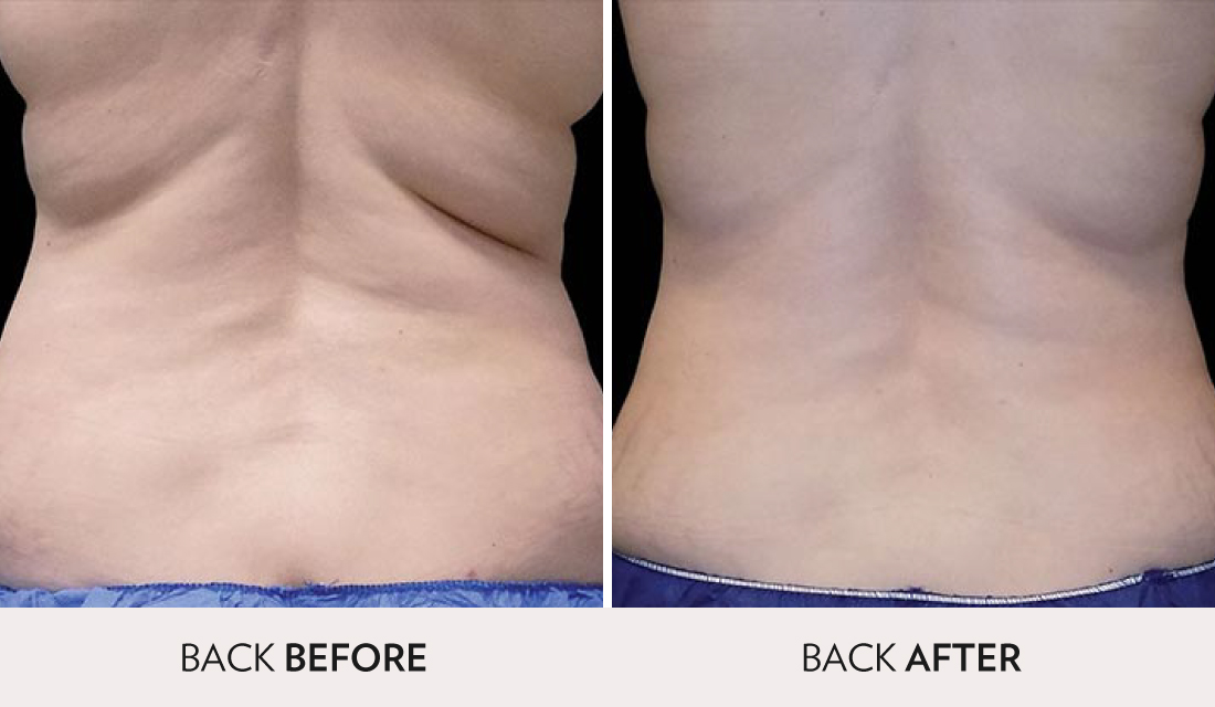 CoolSculpting Before After | Spa Radiance Medical | San Francisco Med Spa